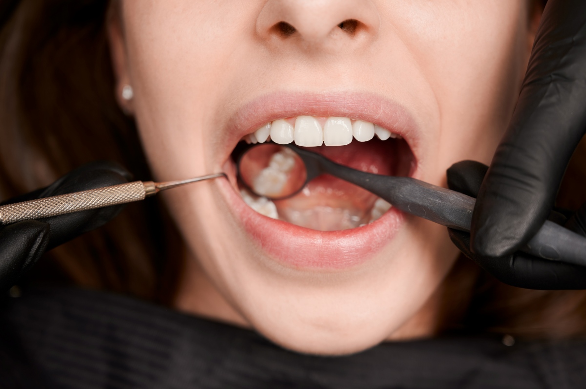 dental bonding near you