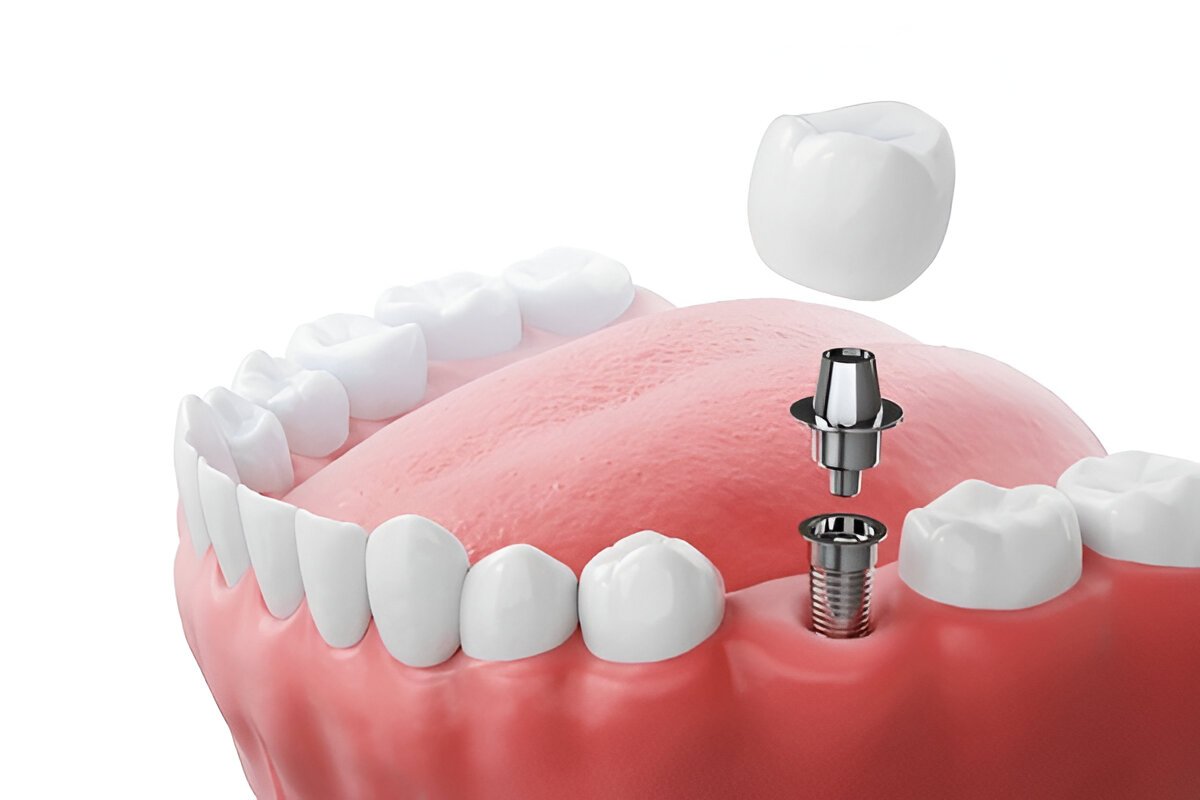 dental implants in etobicoke, on