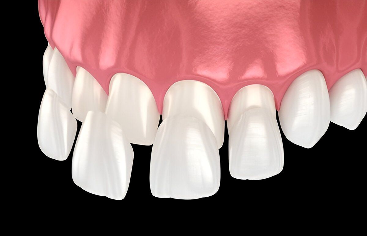 porcelain veneers near you